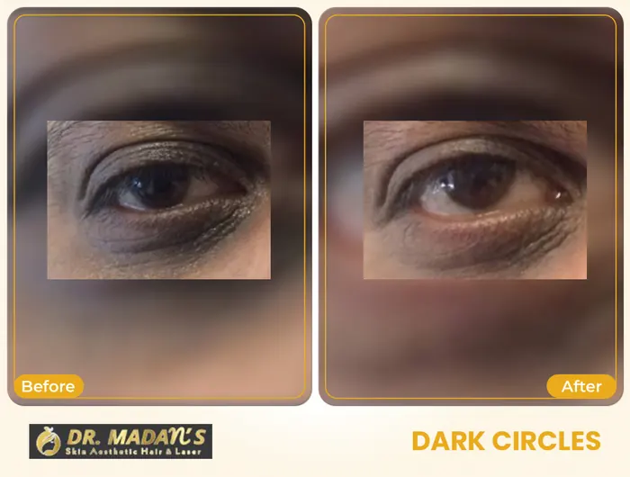 Dark circles before and after result 2 at Dr Madan Aesthetics